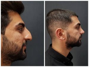 Burun Estetiği Öncesi ve Sonrası Fotoğrafları